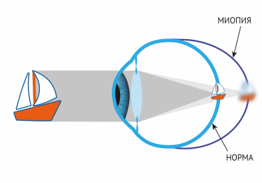 миопия это